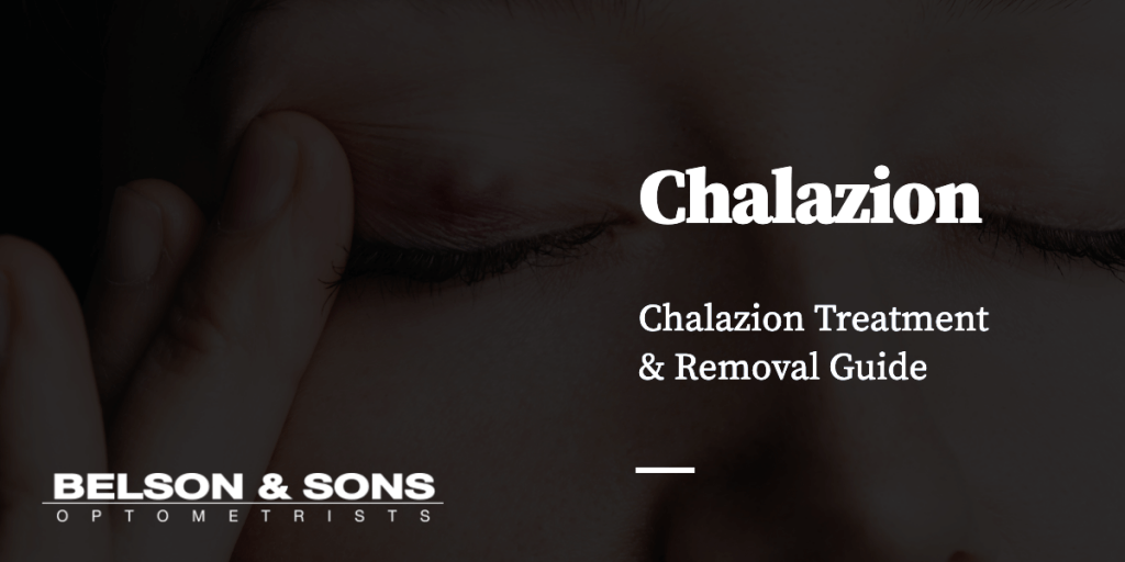 Chalazion Treatment & Removal Guide - Belson Opticians
