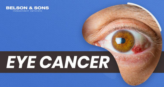 Eye Cancer – Symptoms and Treatment - Belson Opticians