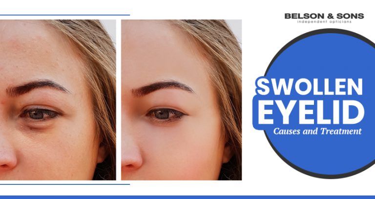 Swollen Eyelid: Causes and treatment - Belson Opticians