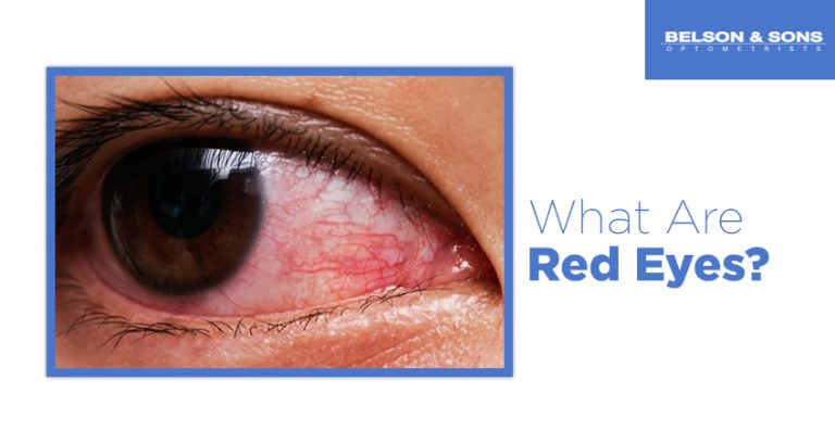 What Are Red Eyes? - Belson Opticians
